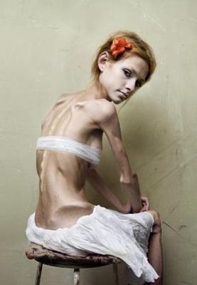 anorexia